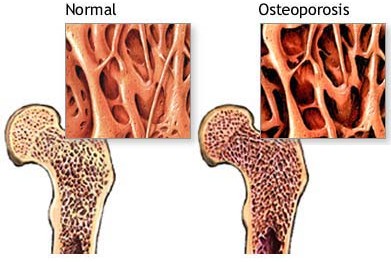Obat Osteoporosis Untuk Lansia